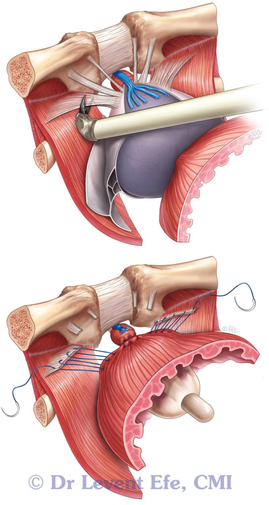 Bladder neck-urethra angle
