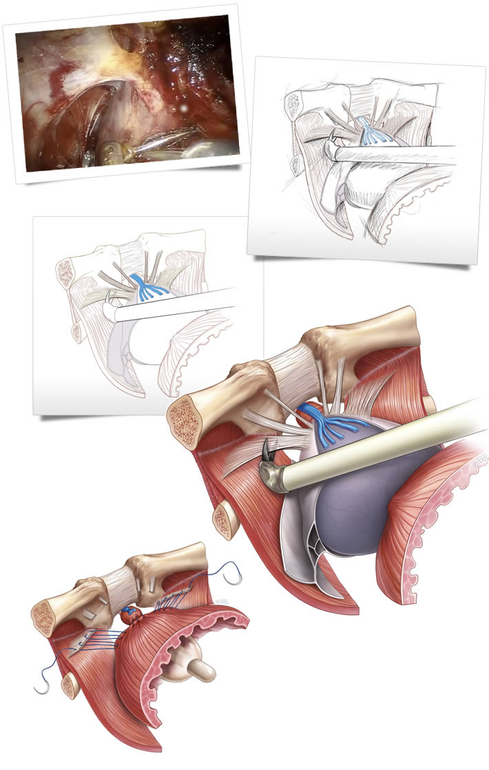 Process of medical illstration - photo to sketch to full colour illustration 