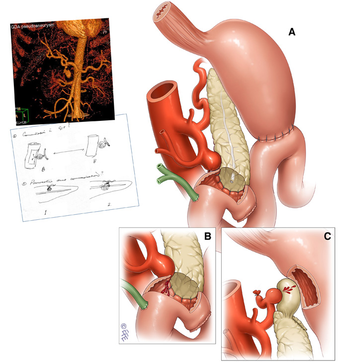 Medical illustration of pancreatic aneurysm in whipple