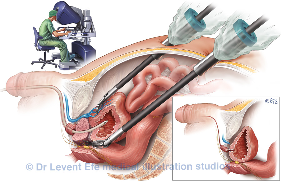 Robotic surgery of the prostate