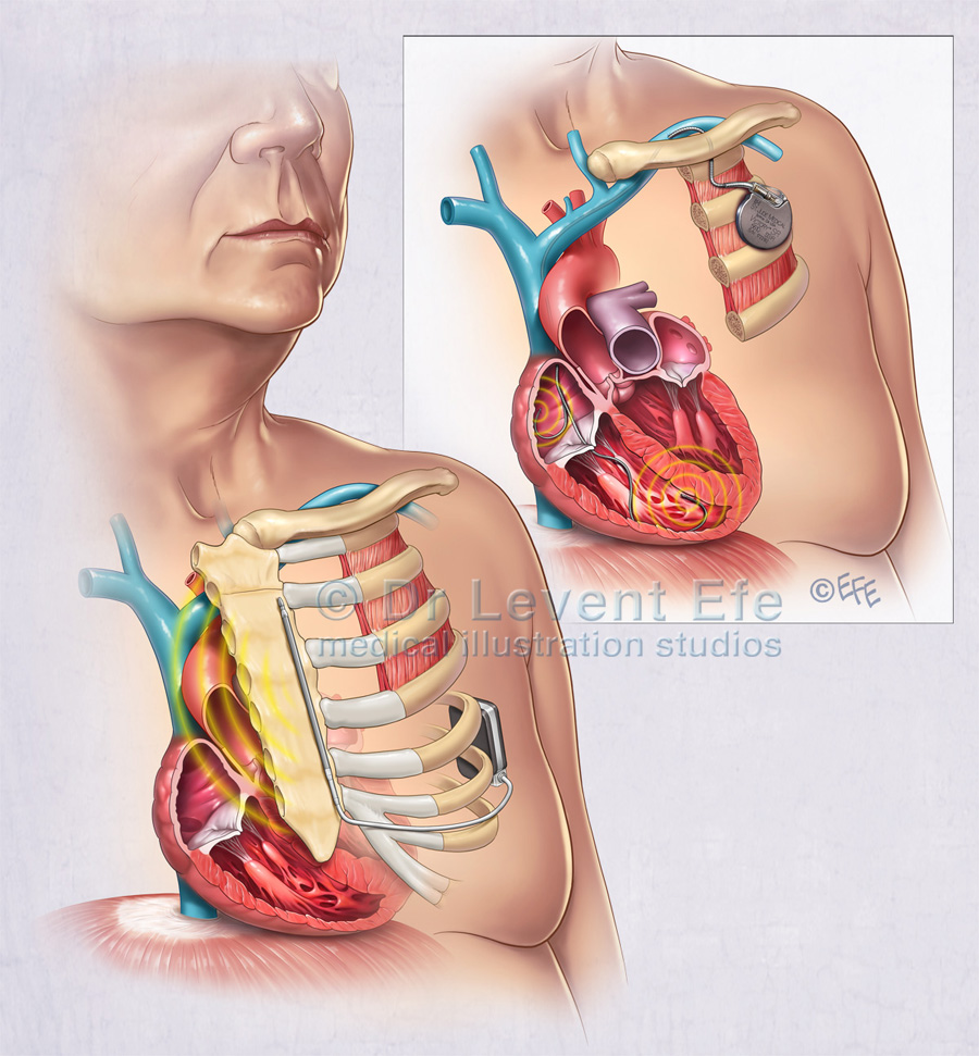 Implantable Cardioverter – Defibrillators