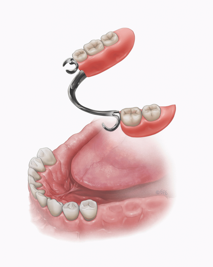 A chrome cobalt partial denture is a durable and long-lasting option, casting into a framework that fits around your natural teeth.