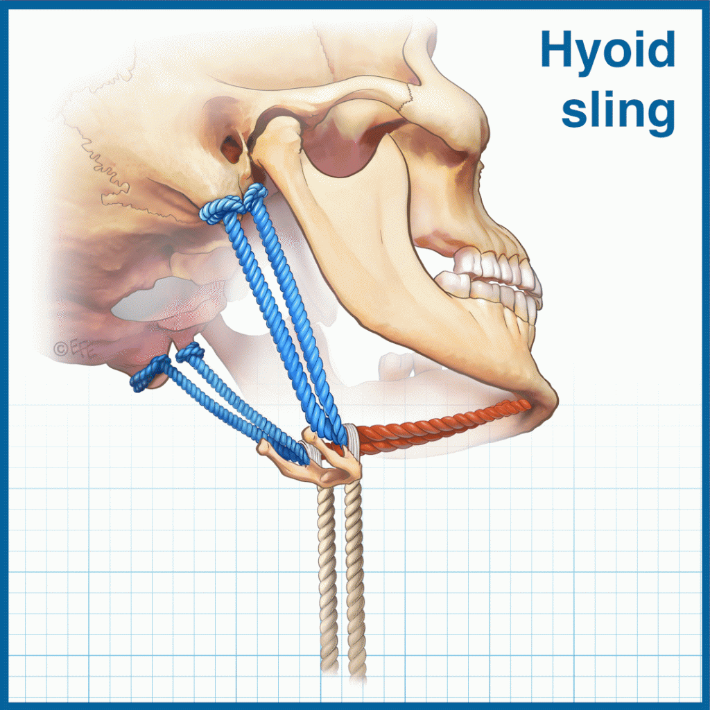 An Animated Graphical Abstract is intended for the author’s and publisher’s social media. Animated GIFs are a relatively new medium that look very attractive in social media, helping authors and journals highlight the most crucial aspects of their argument. The sling analogy is here to communicate how the hyoid bone is suspended with muscles, and how it changes its location with aging. The growing object within the mouth represents the increasing mass of soft tissue, and the color-coded ropes are the digastric and infrahyoid muscle groups. Soft tissues push the hyoid bone downward and forward, causing an obtuse cervicomental angle. As the location of the hyoid bone is an important parameter in surgical planning, the sling analogy is used to hit home the message about the bone’s gravitation.